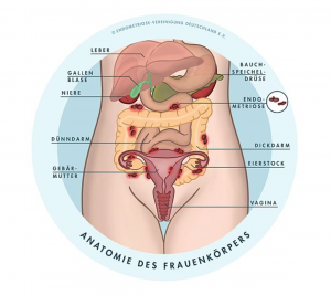www.endometriose-vereinigung.de